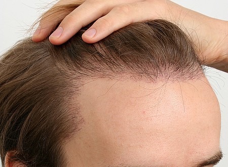 Tout savoir sur la greffe des cheveux avant de se lancer