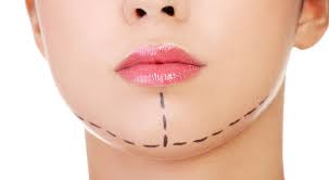 La génioplastie ou chirurgie du menton