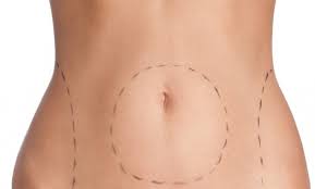 Comprendre la lipectomie d’aspiration avant de se lancer