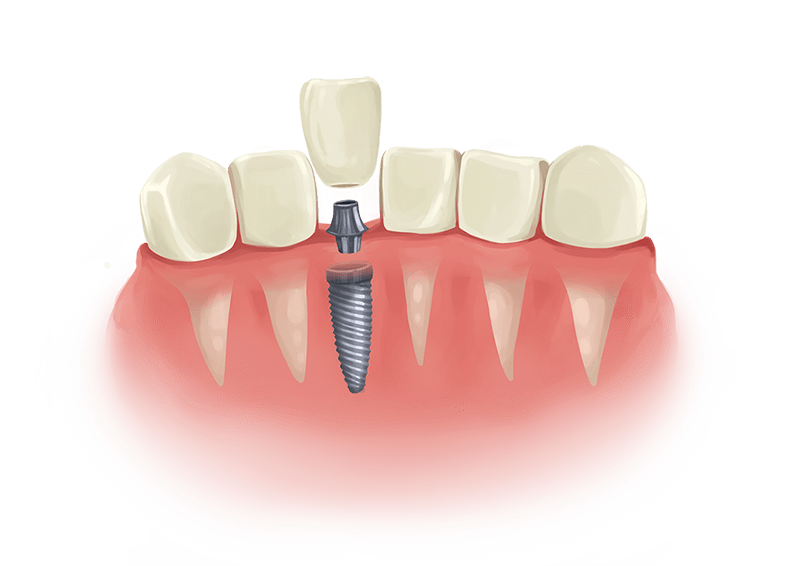 Les conséquences d’une dent manquante ?