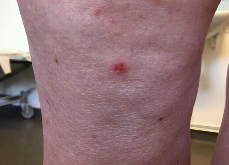 Ce que vous devez savoir sur l’atopie